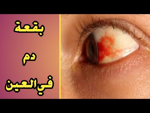 الدم في العين ما هي أسبابه و كيف يعالج هل هو خطير