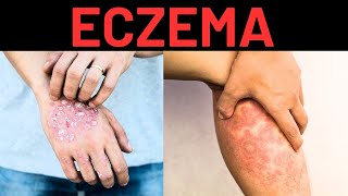 What is Eczema and Why it Occurs? Symptoms, Treatment, Causes