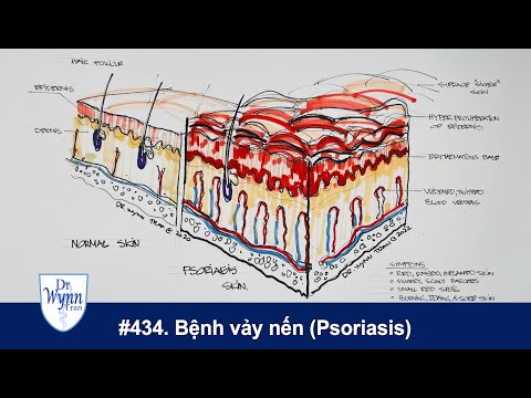 Video: 3 cách chẩn đoán bệnh vẩy nến