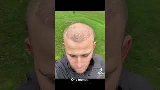 HAIR TRANSPLANT BEFORE AFTER - 11 MONTHS