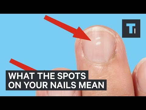 What white marks on nails mean about health