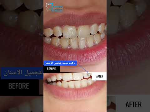 مركز الدكتور محمد عمارة لتجميل الأسنان تجميل الاسنان أسنان تركيب ماسه لتجميل الاسنان