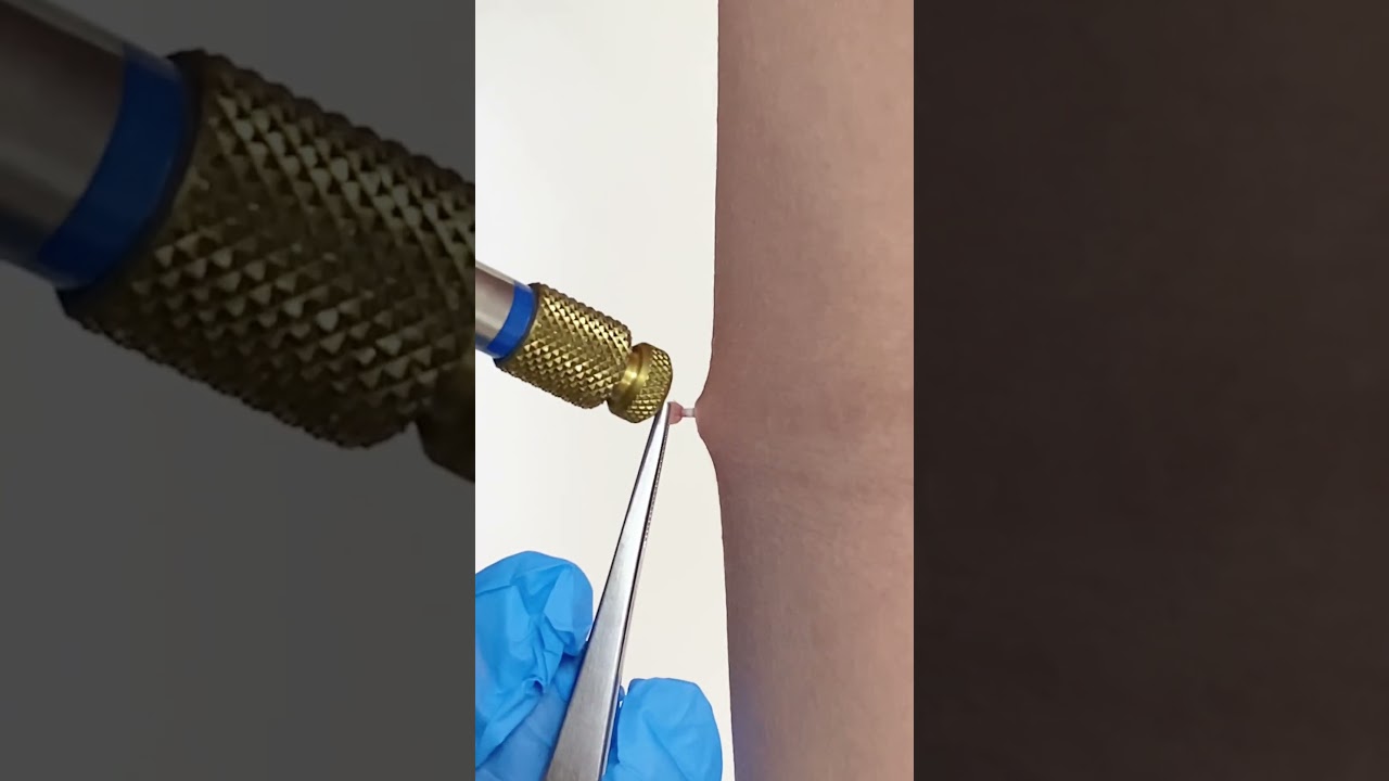 Удаление папилломы жидким азотом