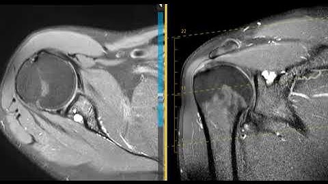 Shoulder pain from labral tear with paralabral cyst