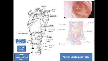 Che differenza c'è tra tracheostomia e tracheotomia?