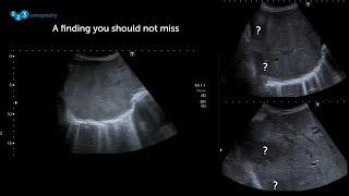 Spring Ultrasound Knowledge Booster #8: A finding you should not miss!