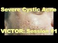 Severe Cystic Acne - Victor: Session #1