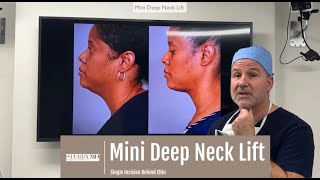 Mini Deep Neck Lift | Dr. Sterry Explains
