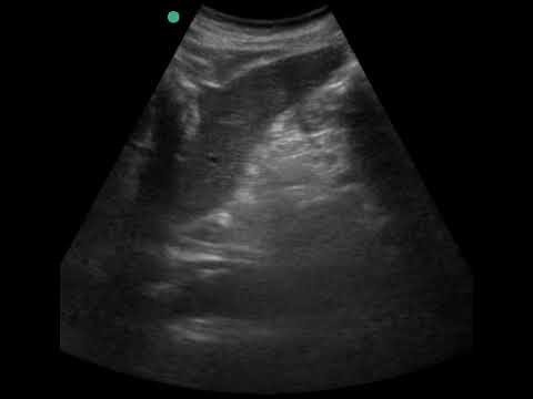 Type B Aortic Dissection Flap on Transabdominal Sagittal POCUS
