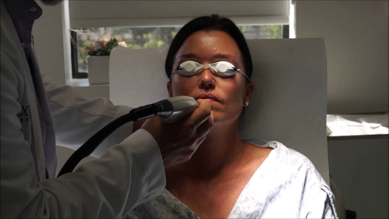 Dr. Amron treats patient with VBeam