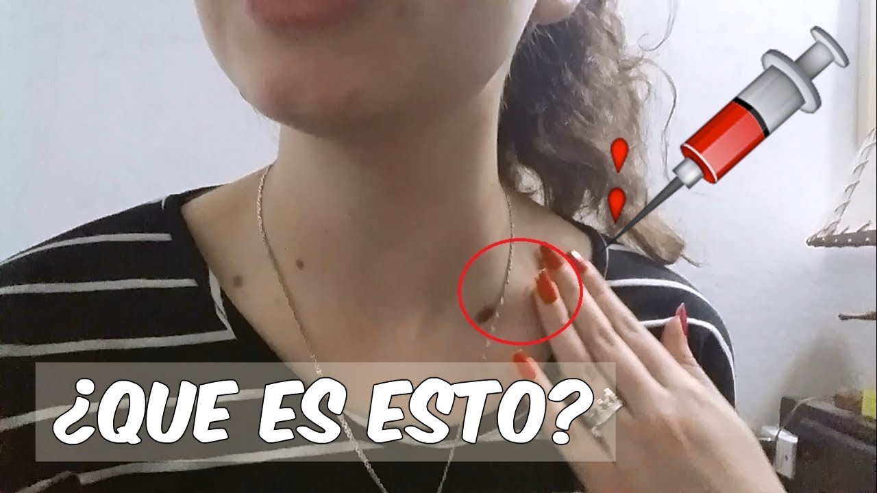 What do I have on my neck?? mansilla de las mulas to leon
