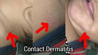 Contact Dermatitis due to faulty feeding Hypopigmented patches