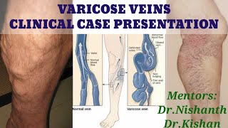 VARICOSE VEINS Clinical case presentation