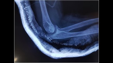 Arthrodesis Elbow CPT code - simplify medical coding