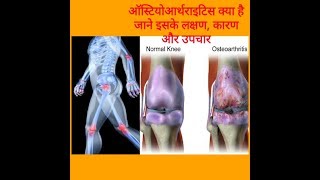 ऑस्टियोआर्थराइटिस क्या है जाने इसके लक्षण, कारण और उपचार IN Hindi...