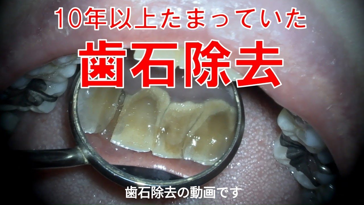 歯石 取り めちゃくちゃ 痛い