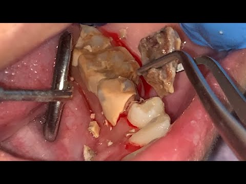 PECAHAN KARANG GIGI | Dentist | Dokter Gigi Tri Putra