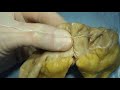 End-to-end intestinal anastomosis technique (part 3: seromuscular Lembert sutures)