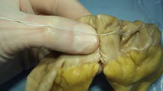 End-to-end intestinal anastomosis technique (part 3: seromuscular Lembert sutures)