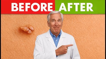 Remove Skin Tags & Warts Overnight – Simple Natural Method