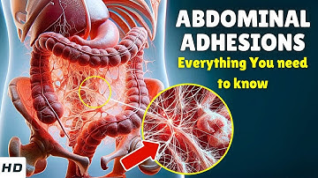 Abdominal Adhesions – Causes, Signs and Symptoms, Diagnosis & Treatment