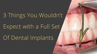 3 Things you wouldn't expect with a full set of dental implants or All on 4