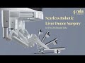 Watch prof mohamed rela performing a scarless robotic liver donor surgery