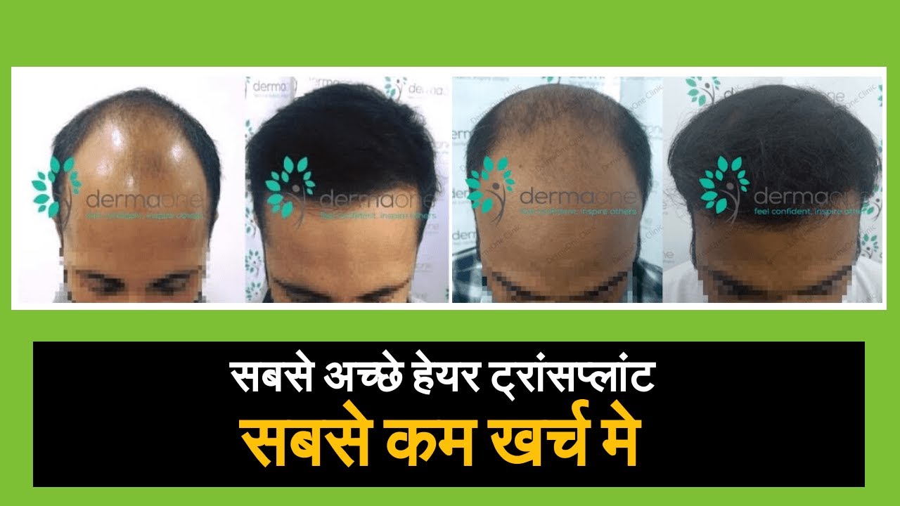 Cost of Hair Transplant in India Hair Transplant में कितना खर्चा होता है (in HINDI) YouTube
