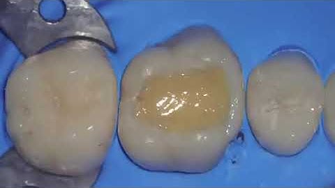 Composite restoration and successive cusp buildup.