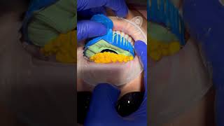 Replacing old composite veneers, she will be getting her final porcelain veneers in 2 weeks! #veneer