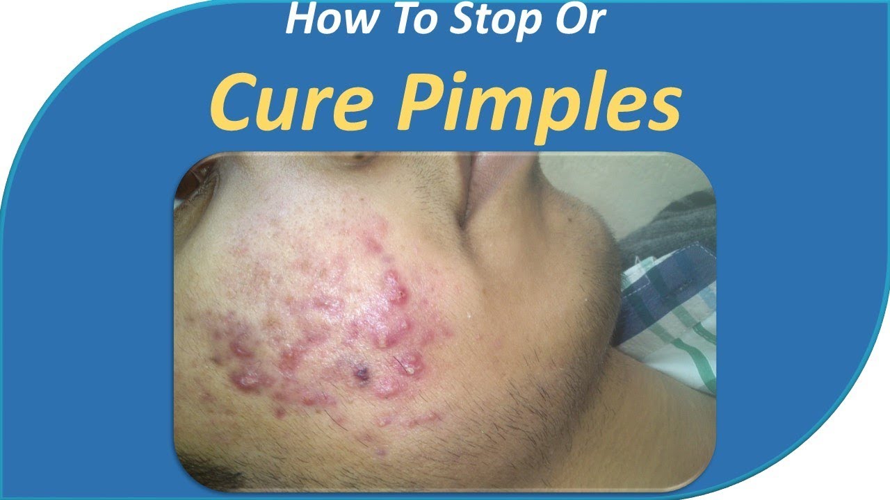How to Stop or Cure Pimples.Use exfoliating treatments and goggles