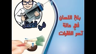 في العضل | منع بلع اللسان في حالة الاصابة العنيفه والكسور