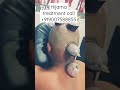 Hijama Treatment in Kolkata | Hijama Center #shorts #short