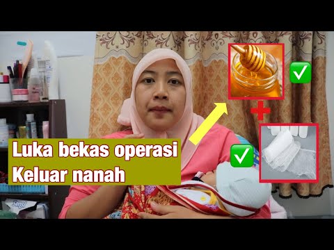 Merawat Luka Pasca Operasi Caesar | INFEKSI