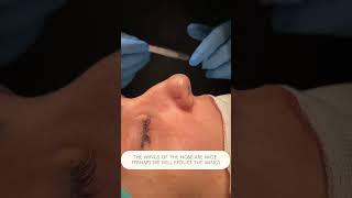 Green Zone Talks 10-Kapalı Rinoplasti / Closed Rhinoplasty #rhinoplastyistanbul #closedrhinoplasty