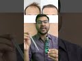 Correct Way To Use Minoxidil Hair Regrowth Solution Best Results Available On Surgeryonline App mp3