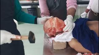 Steps of Autopsy Dissection