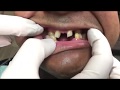 Houston Cosmetic Dentist ... underbite for Snap-on Smile ... and you can eat!!