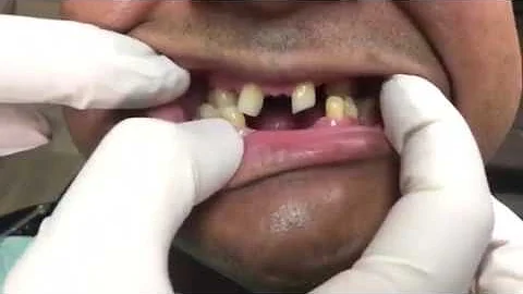 Achieve a Harmonious Smile with Snap-On Smile: The Revolutionary Solution for Underbites