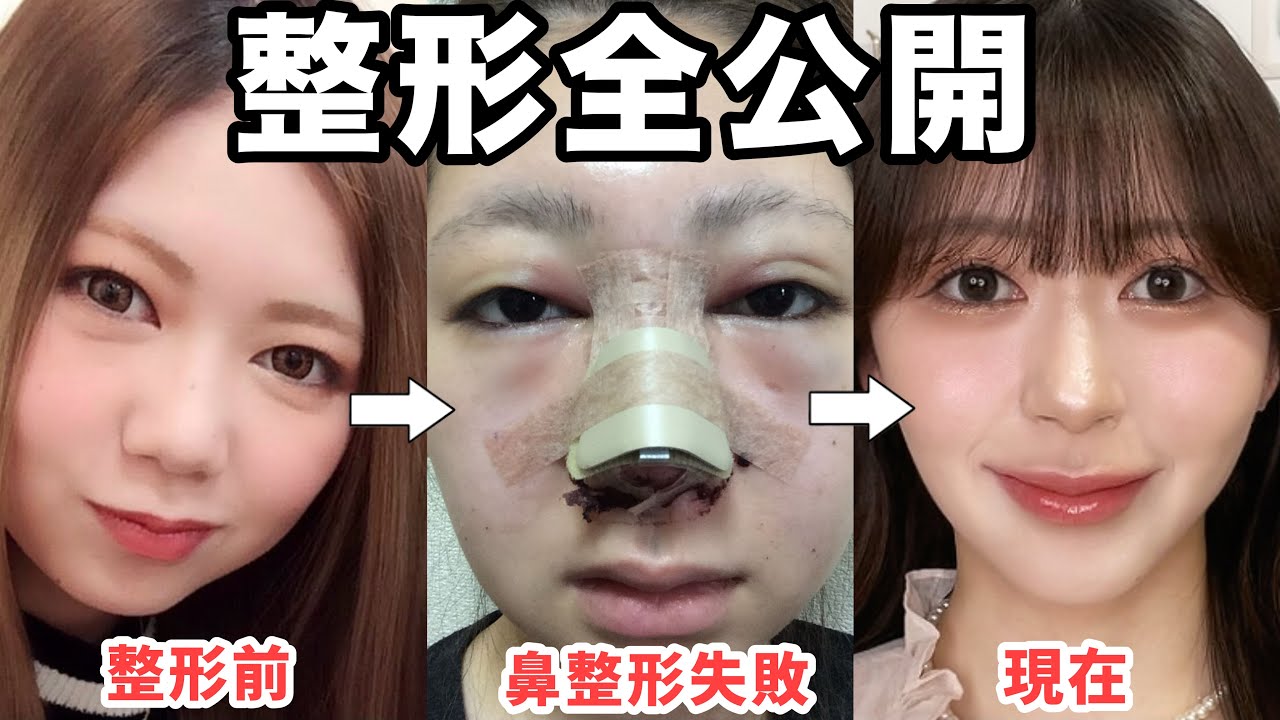 【写真付き】今までやった整形を全て教えます。鼻整形失敗、修正手術、傷跡や後遺症についても暴露する。 - YouTube