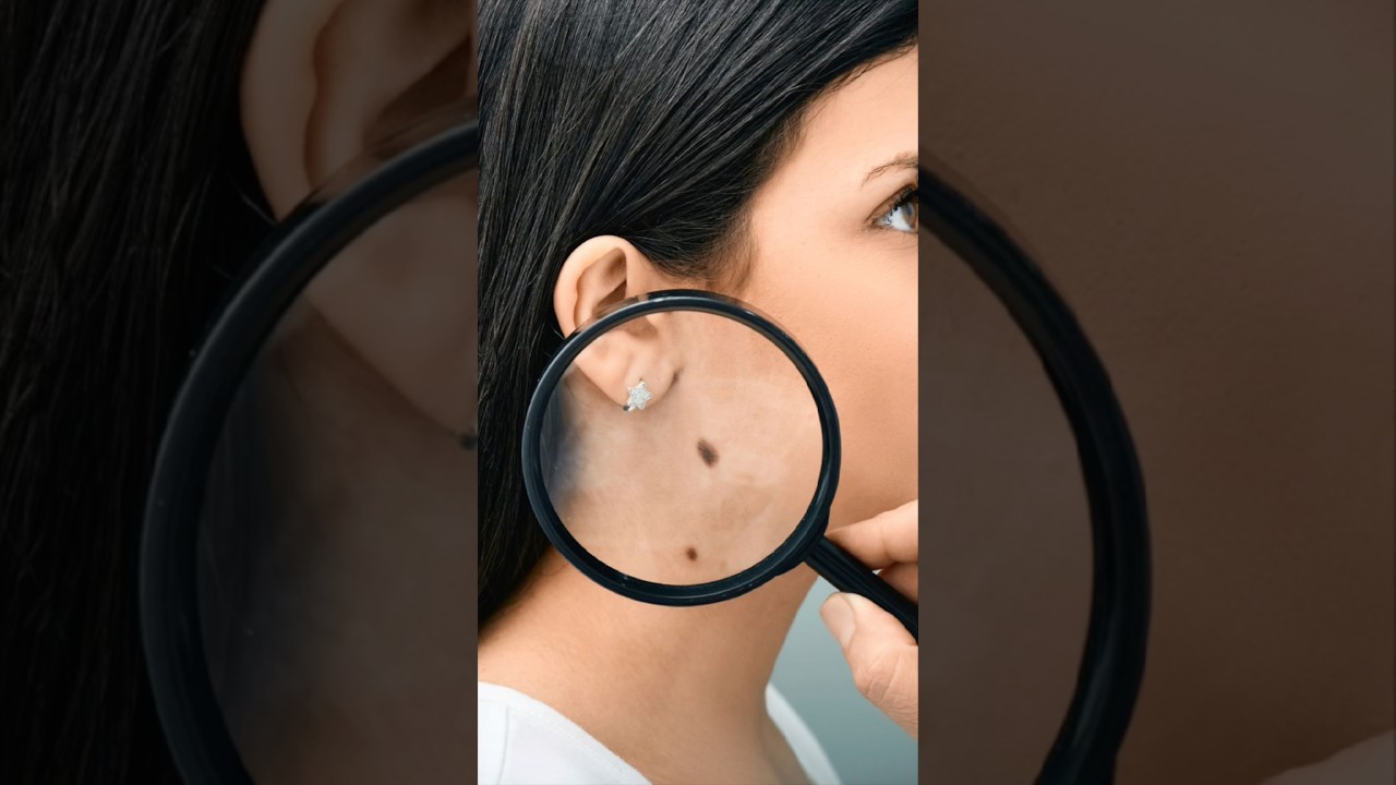 Зачем мы удаляем эти родинки? 