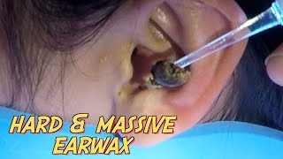 耳掃除の難聴 最大の耳垢除去 Ep 345