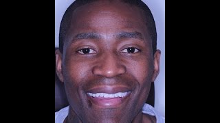 Jamal Crawford Nbas La Clippers Discusses His Whitereyes Eye Whitening Procedure