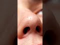 Nose Bridge Detail Cleanse #macroasmr #blackheadcaique #satisfying #blackheadremoval