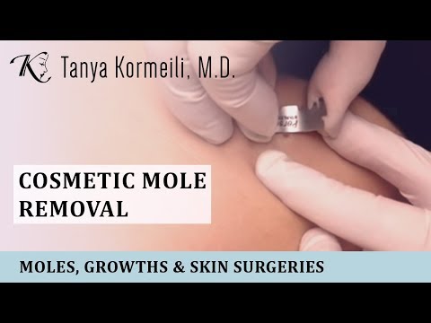 Cosmetic mole removal