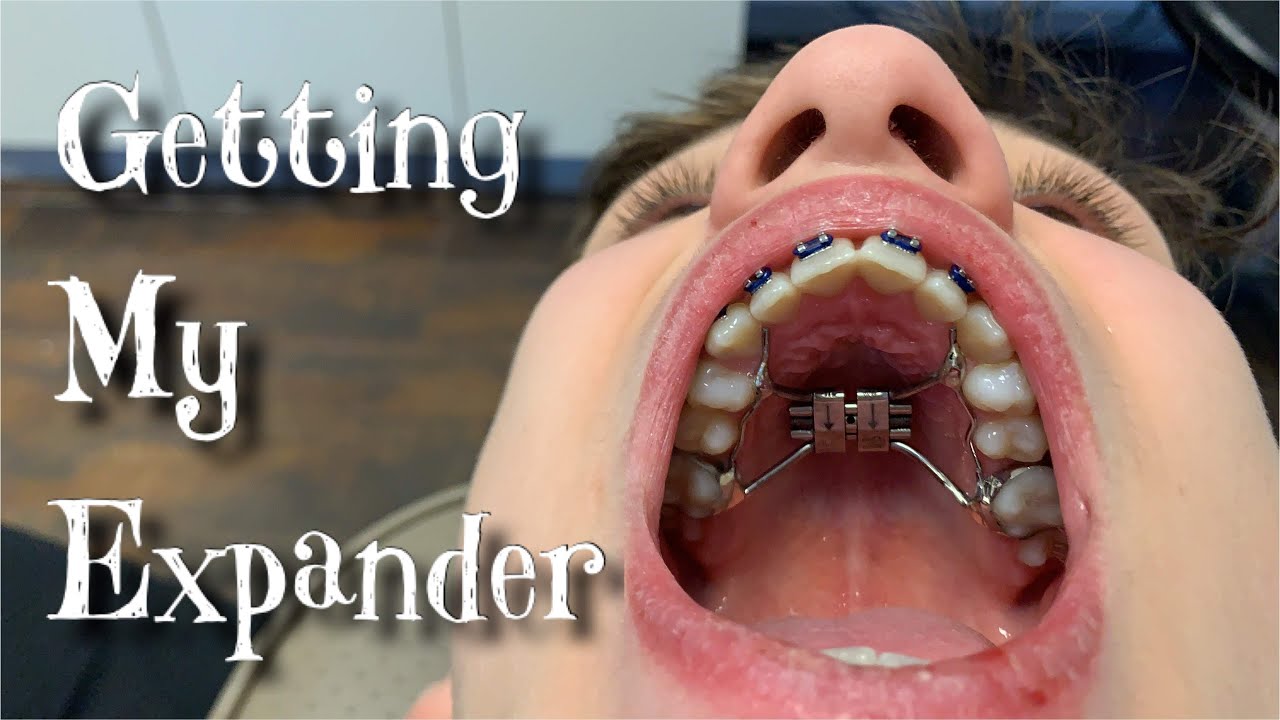 Getting my Expander YouTube