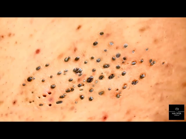 Body Ingrown Hair Extractions | Satisfying Extractions😍