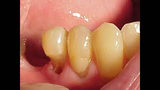 Dental Operative 501 | Lec 5 | Post operative hypersensitivity part 1