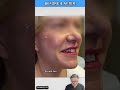 Great plastic surgery results again! #plasticsurgery #beforeandafter #fyp #facelift  #necklift