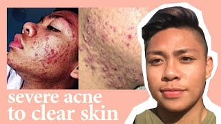 Acne ruined my life | real tips + story time